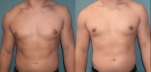 gynecomastie avant apres